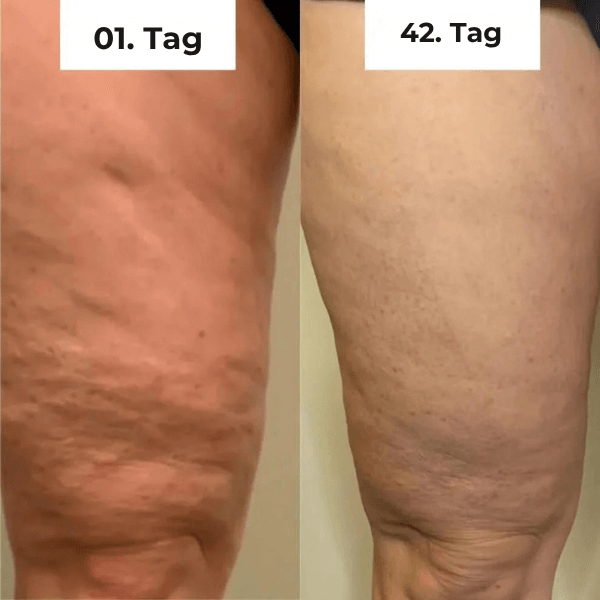 FRAMI SheVitality - Anti-Cellulite Schröpfen Massagegerät