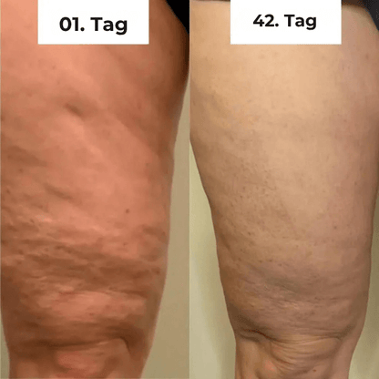 FRAMI SheVitality - Anti-Cellulite Schröpfen Massagegerät