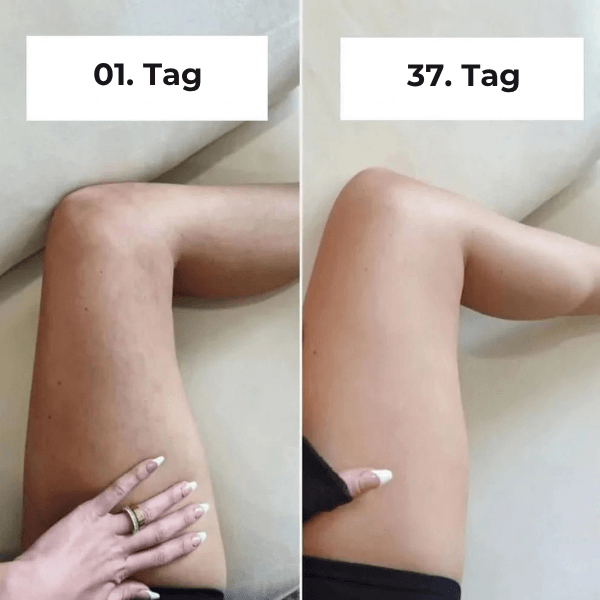 FRAMI SheVitality - Anti-Cellulite Schröpfen Massagegerät