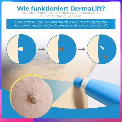 FRAMI DermaLift 2-in-1 - Das Hautanhängsel Entfernungs-Set