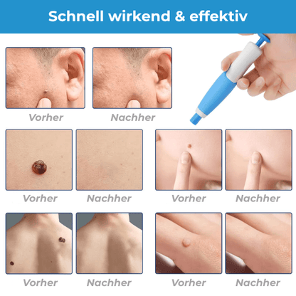 FRAMI DermaLift 2-in-1 - Das Hautanhängsel Entfernungs-Set